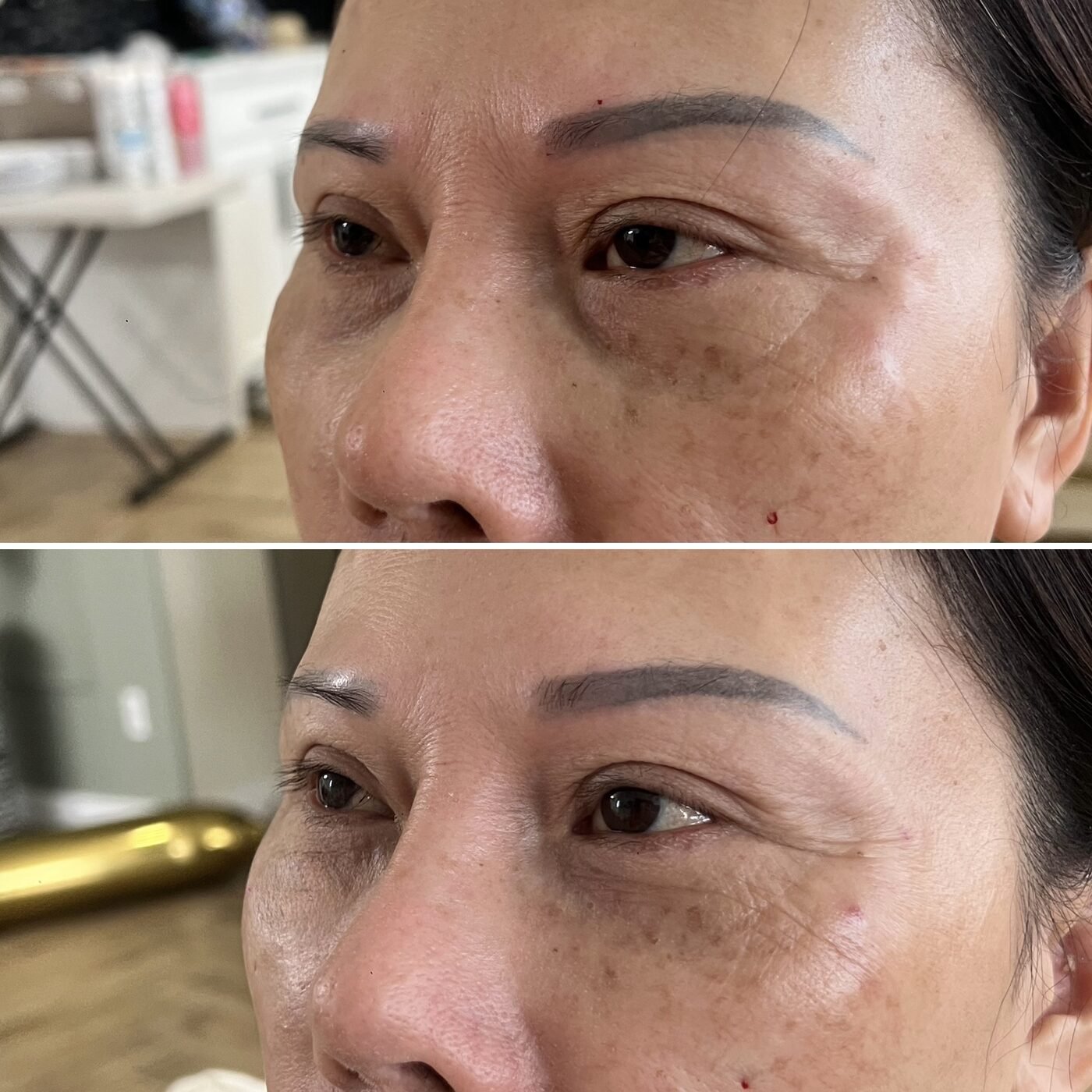Under-Eye before and after — TAI Longevity