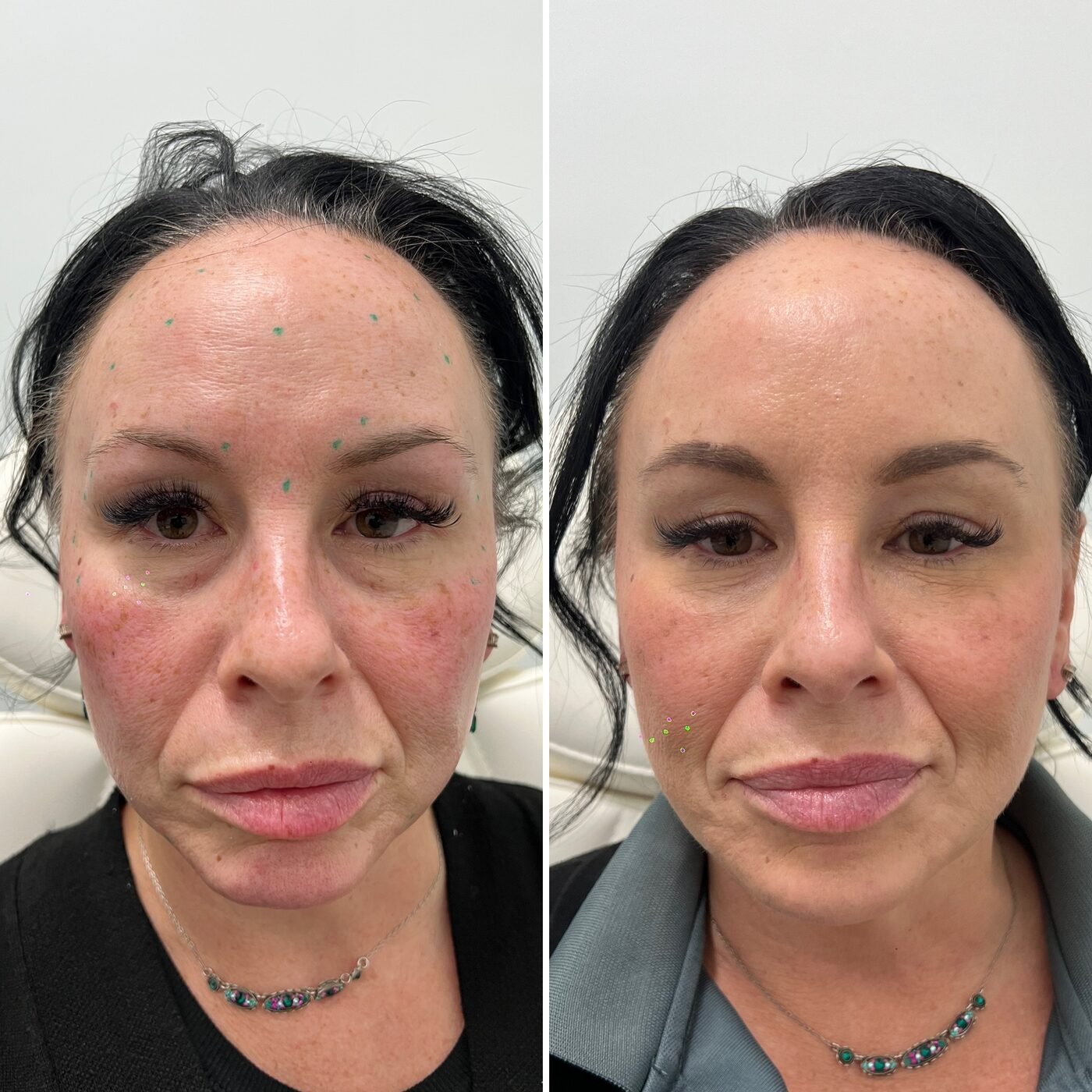 Facial Balancing before and after — TAI Longevity