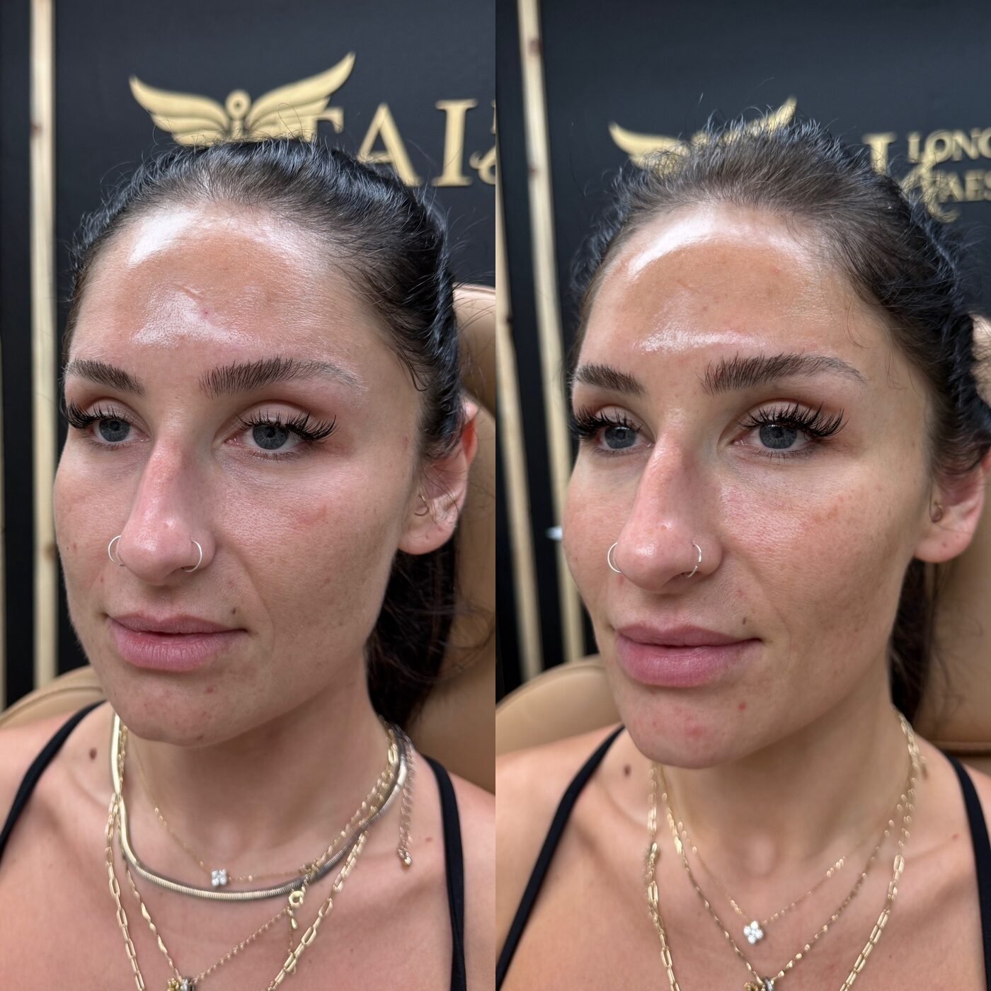 Facial Balancing before and after — TAI Longevity