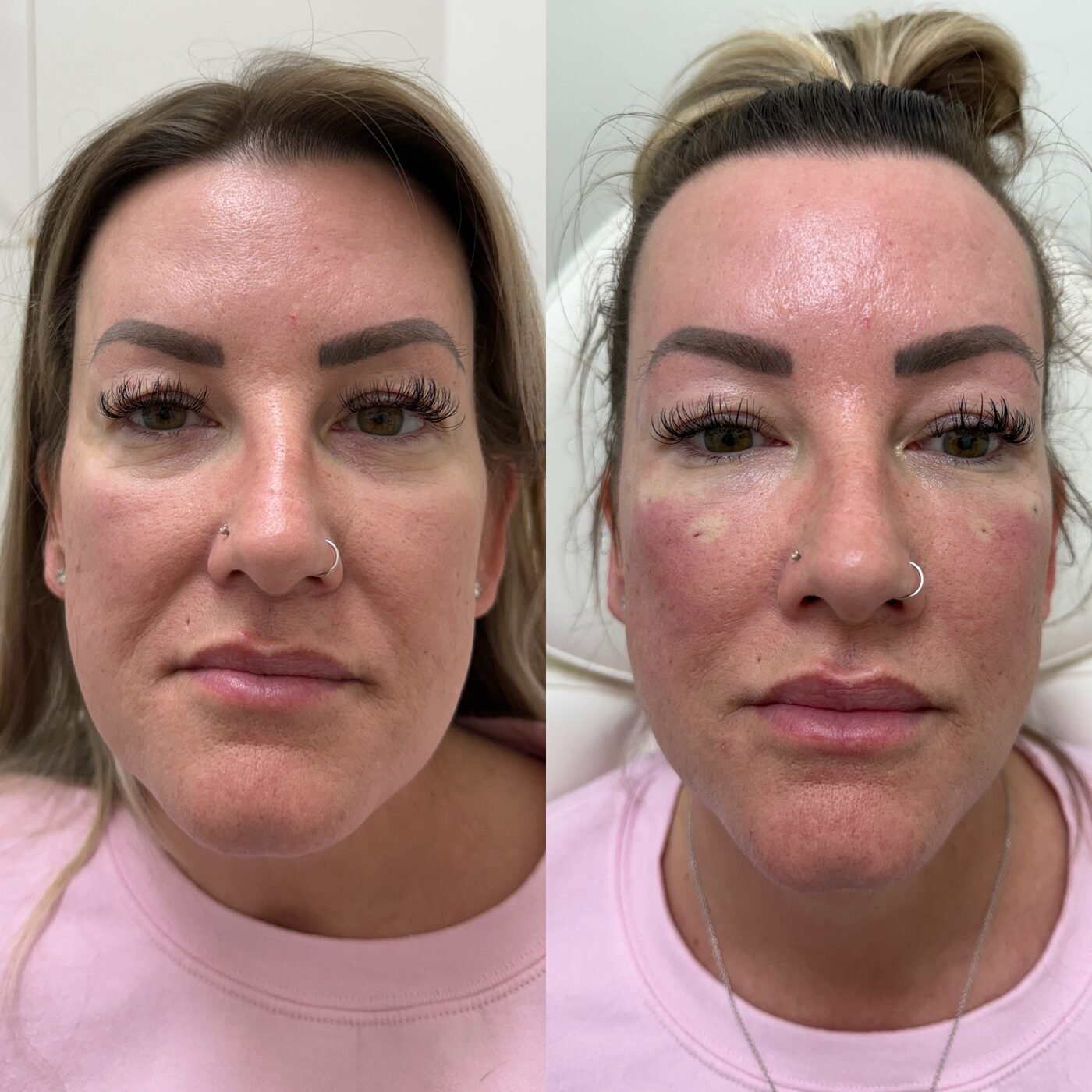 Facial Balancing before and after — TAI Longevity