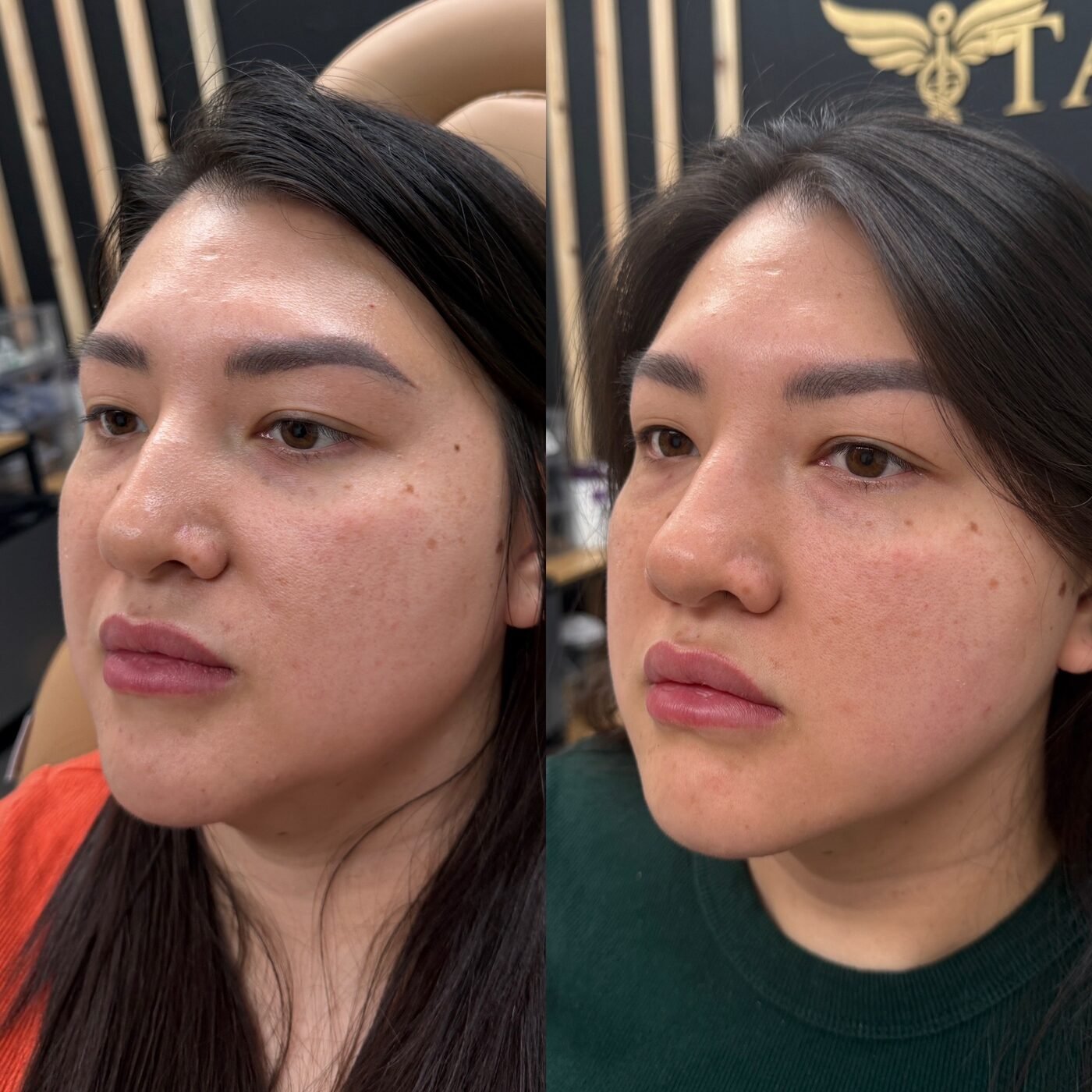 Facial Balancing before and after — TAI Longevity