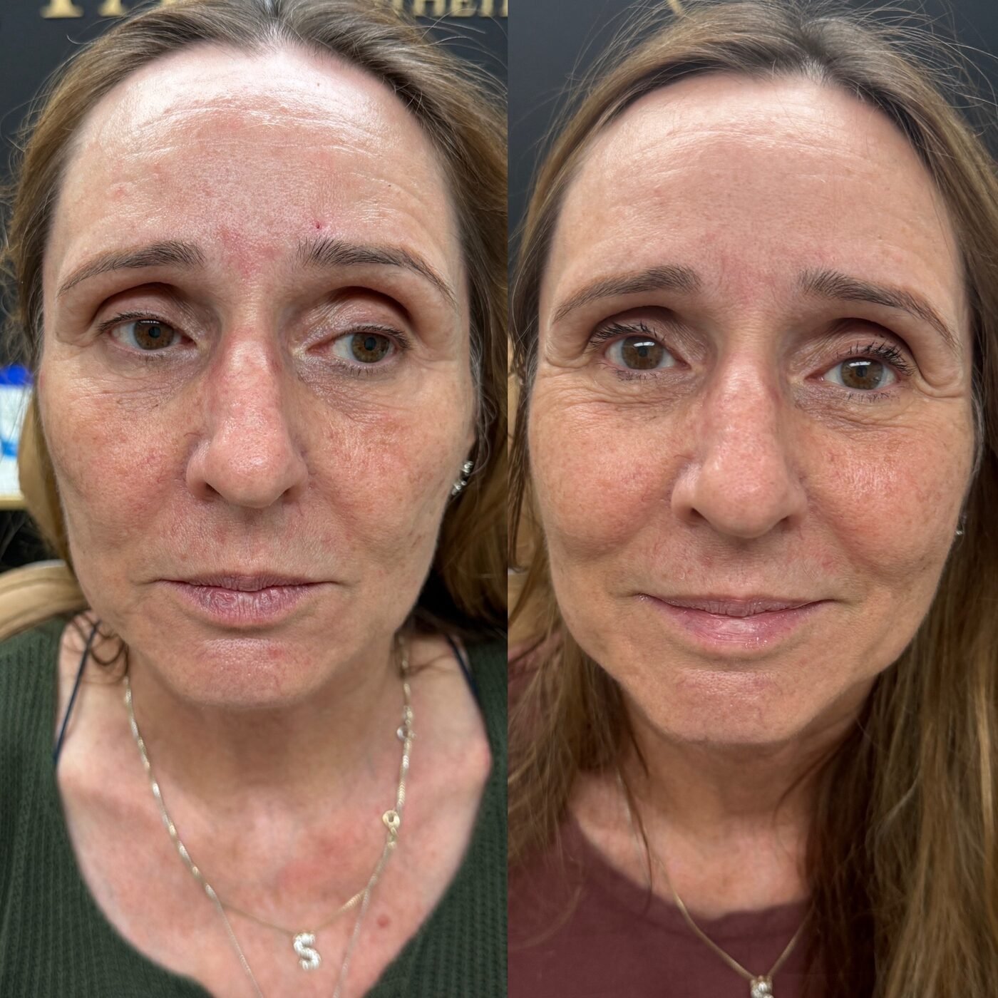 Skin & Texture before and after — TAI Longevity