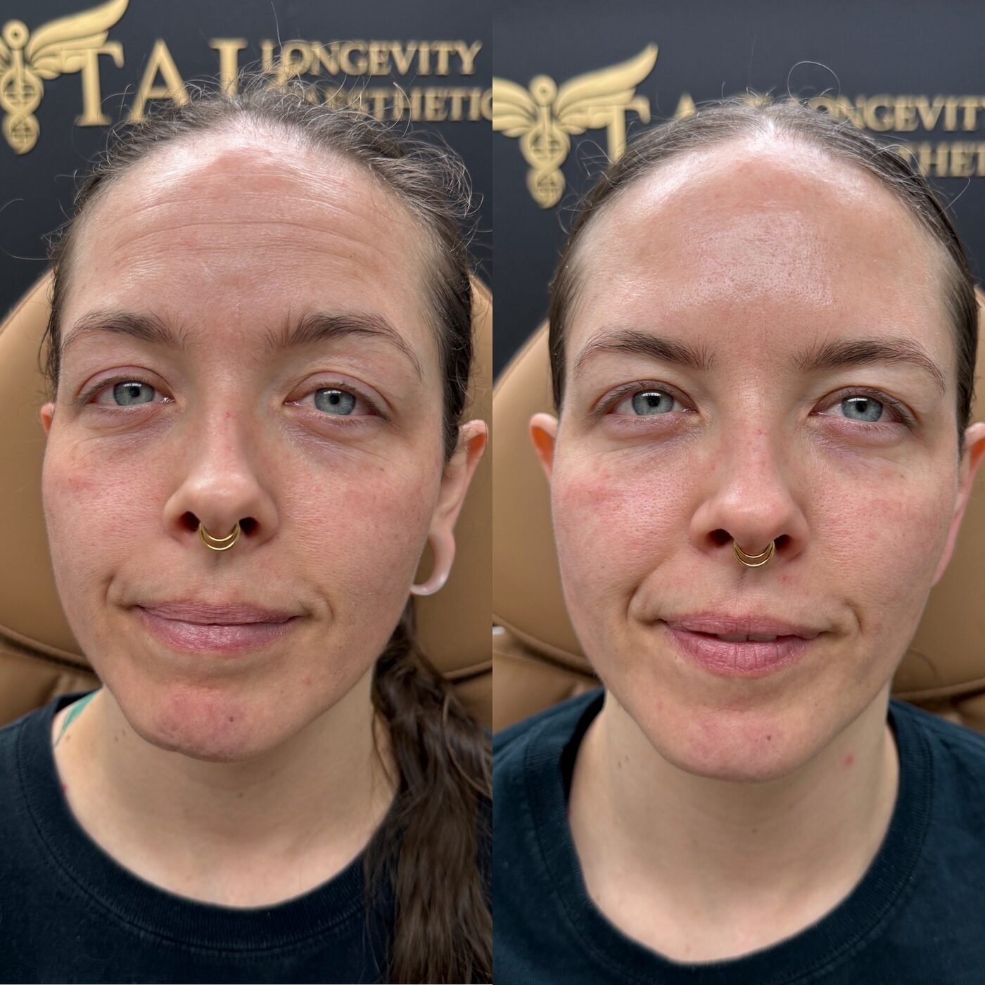 Facial Balancing before and after — TAI Longevity