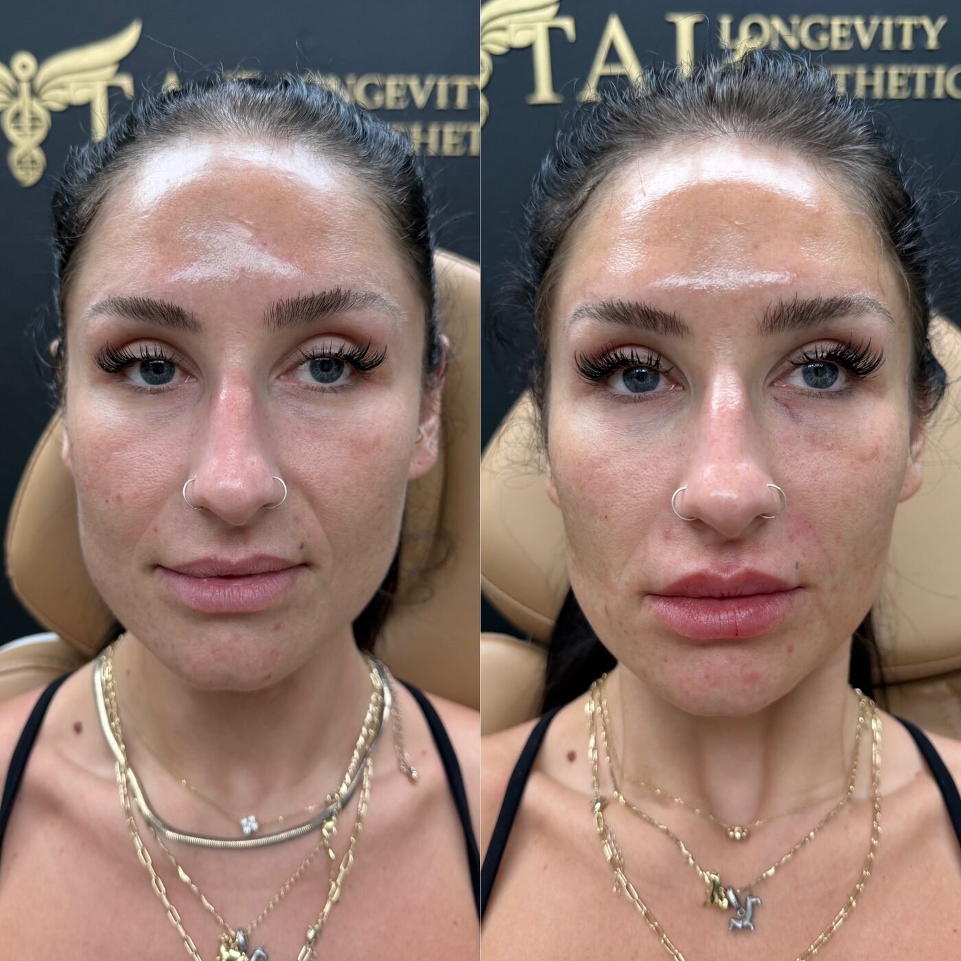 Facial Balancing before and after — TAI Longevity