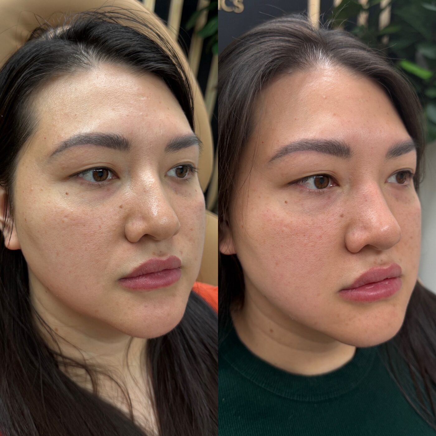 Facial Balancing before and after — TAI Longevity