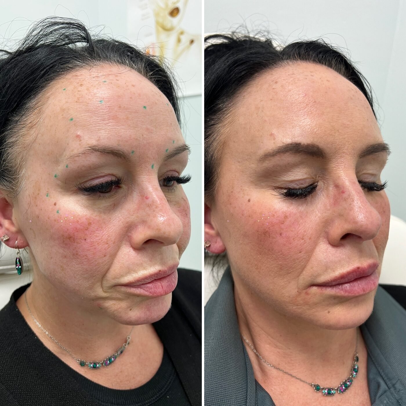 Facial Balancing before and after — TAI Longevity