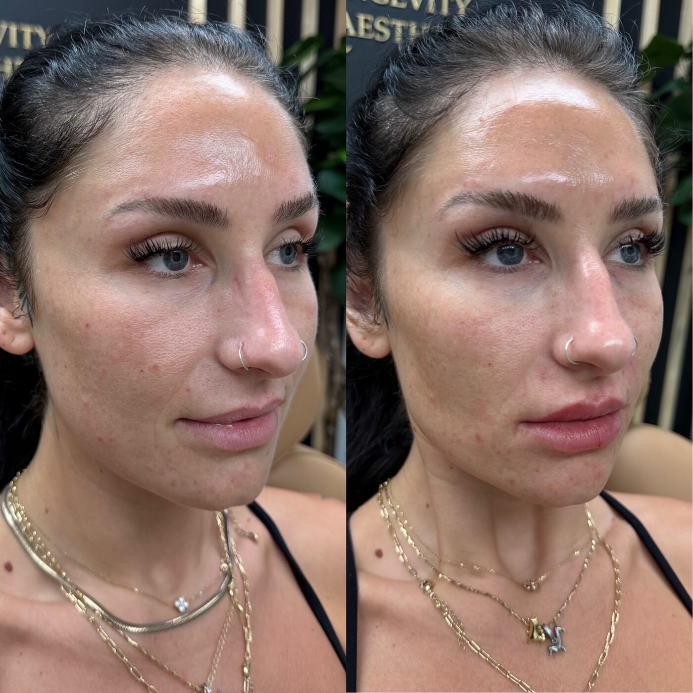 Facial Balancing before and after — TAI Longevity