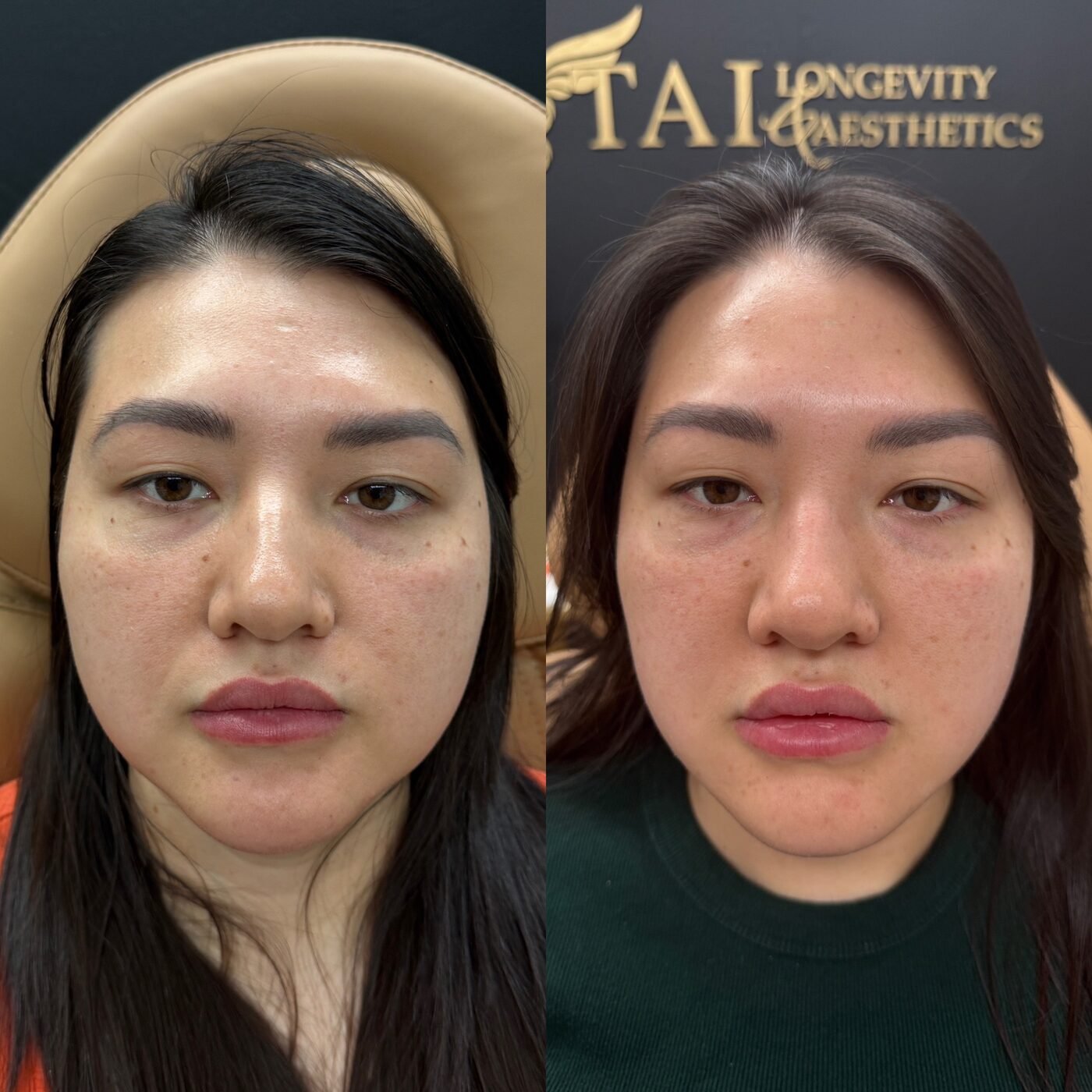 Facial Balancing before and after — TAI Longevity