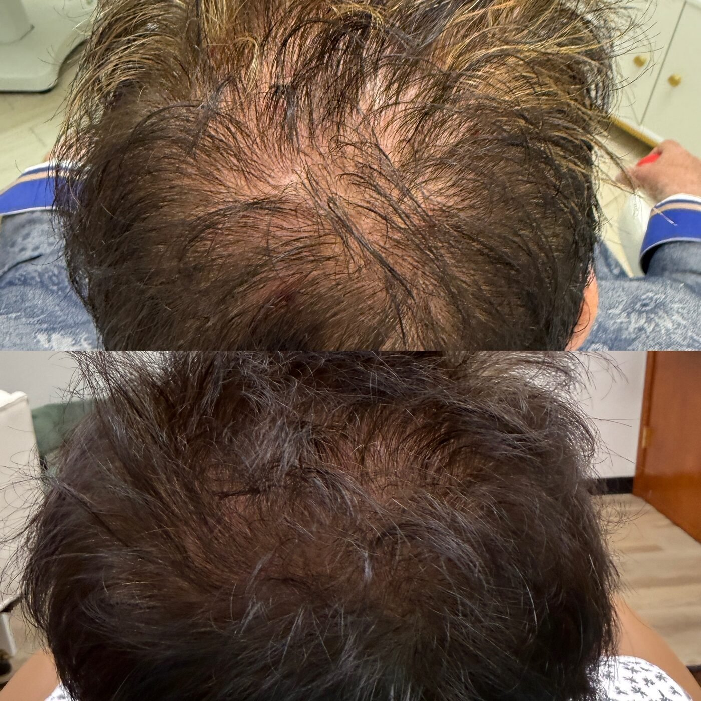 Hair Restoration before and after — TAI Longevity