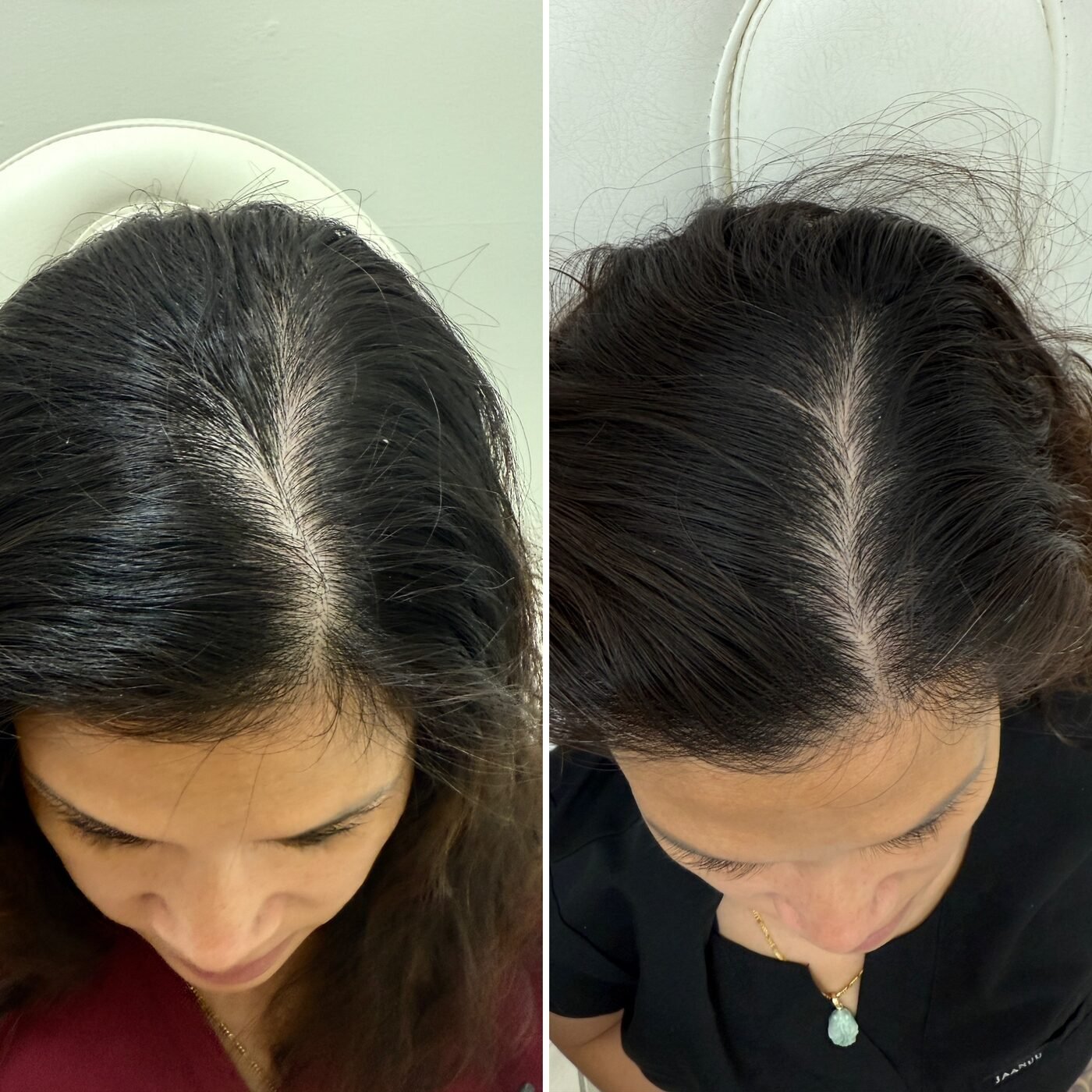 Hair Restoration before and after — TAI Longevity