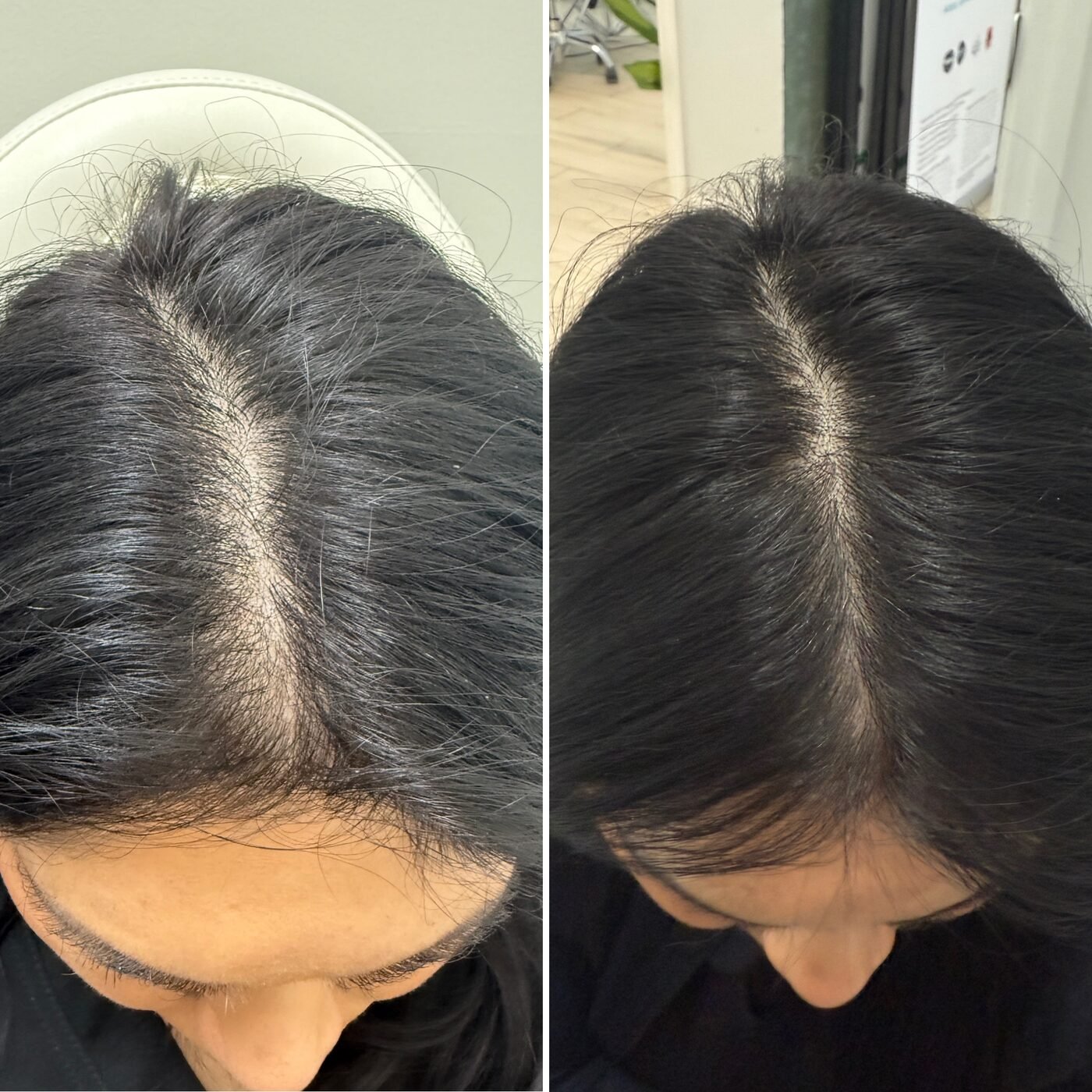 Hair Restoration before and after — TAI Longevity