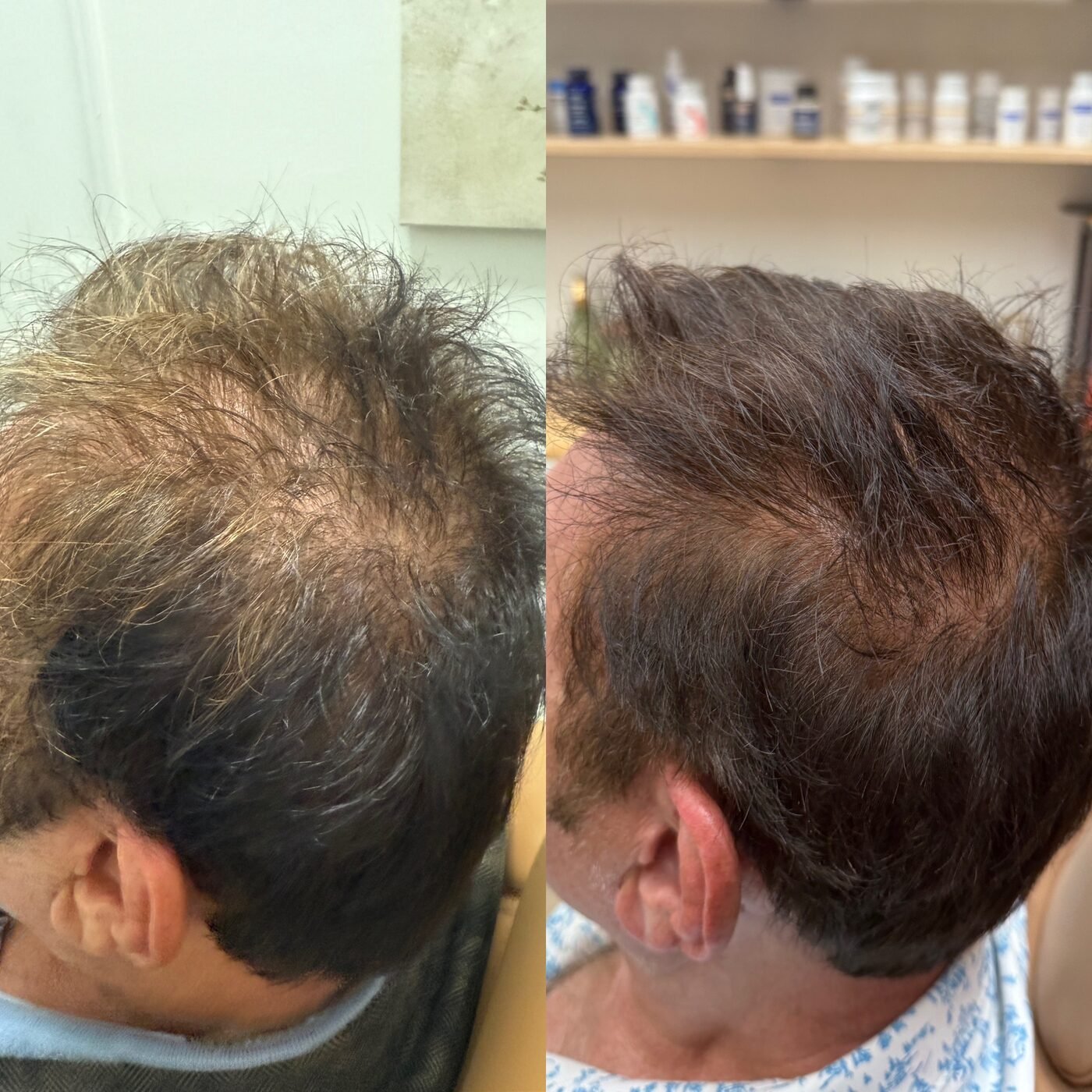 Hair Restoration before and after — TAI Longevity