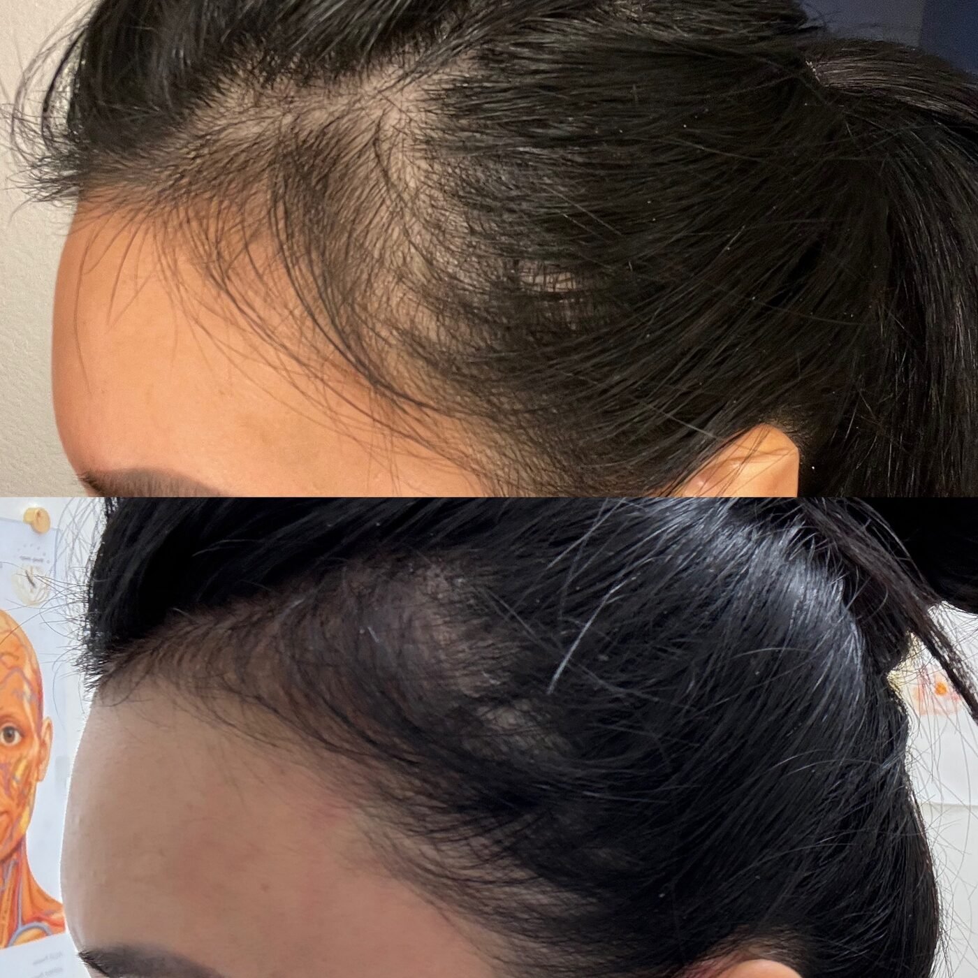Hair Restoration before and after — TAI Longevity