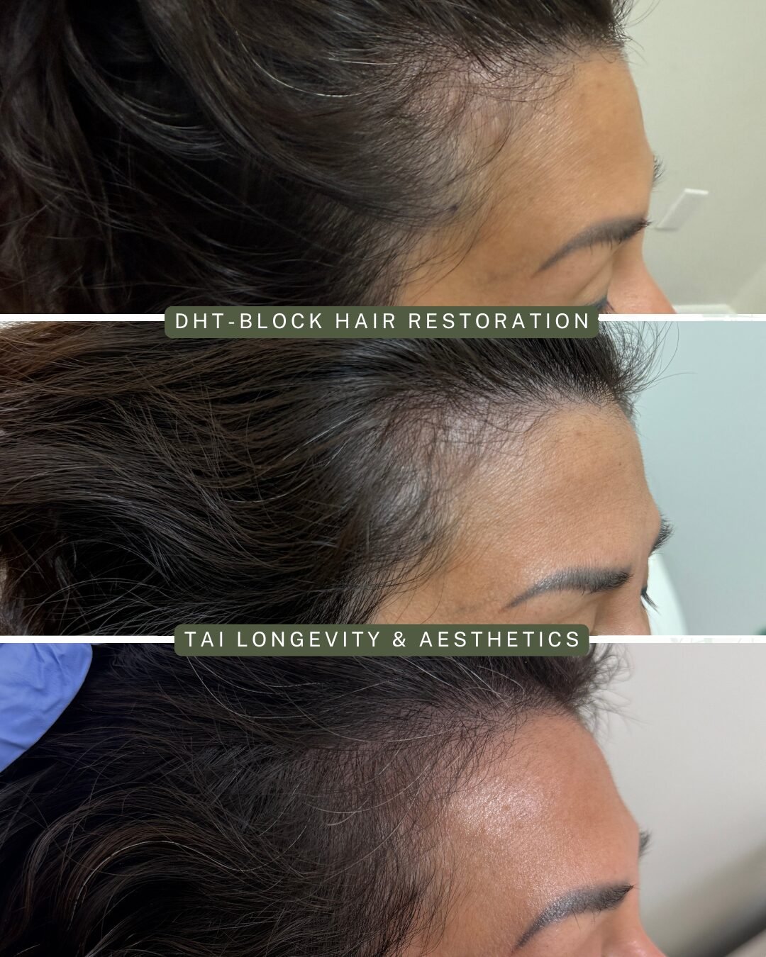 Hair Restoration before and after — TAI Longevity