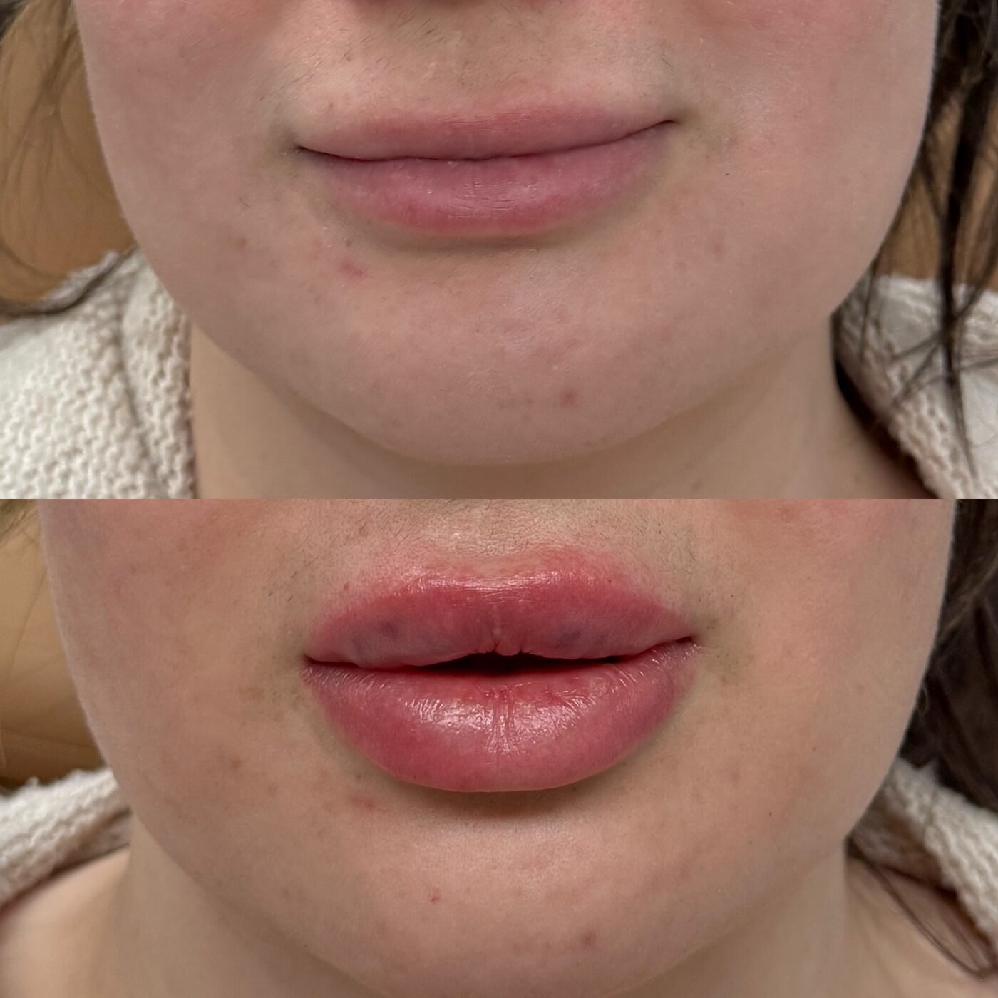 Lip Enhancement before and after — TAI Longevity