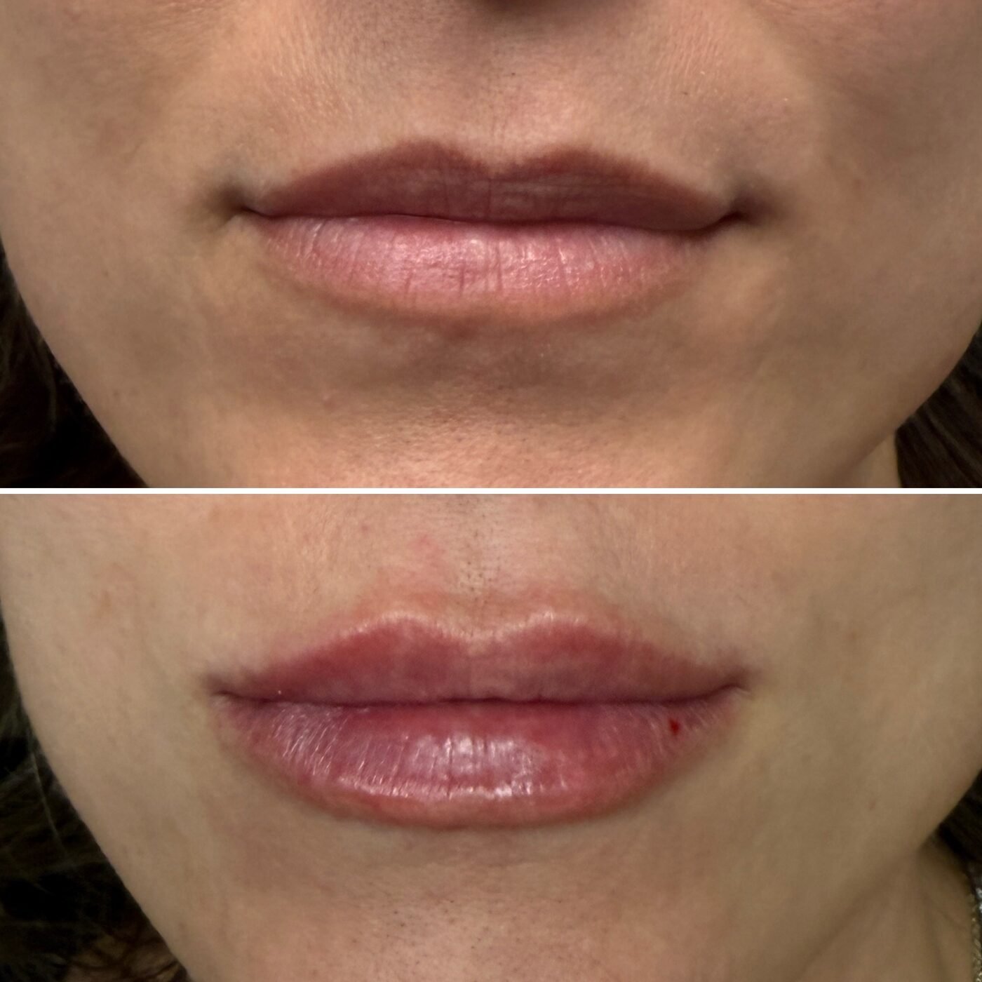 Lip Enhancement before and after — TAI Longevity