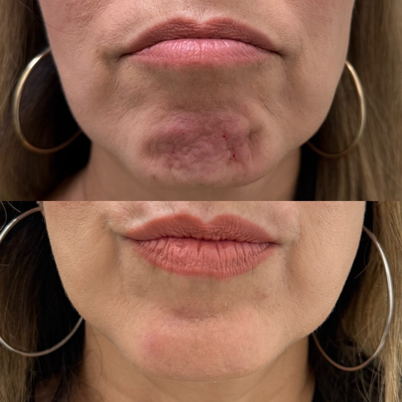 Lip Enhancement before and after — TAI Longevity