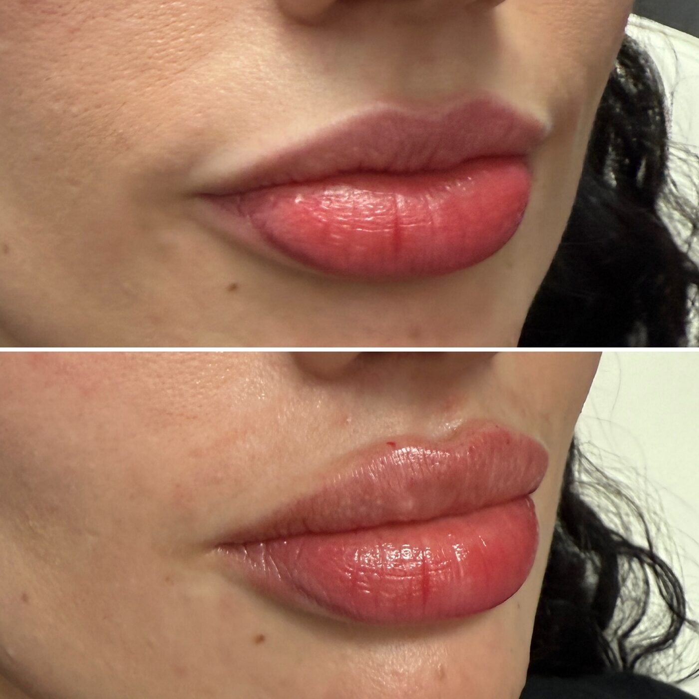 Lip Enhancement before and after — TAI Longevity