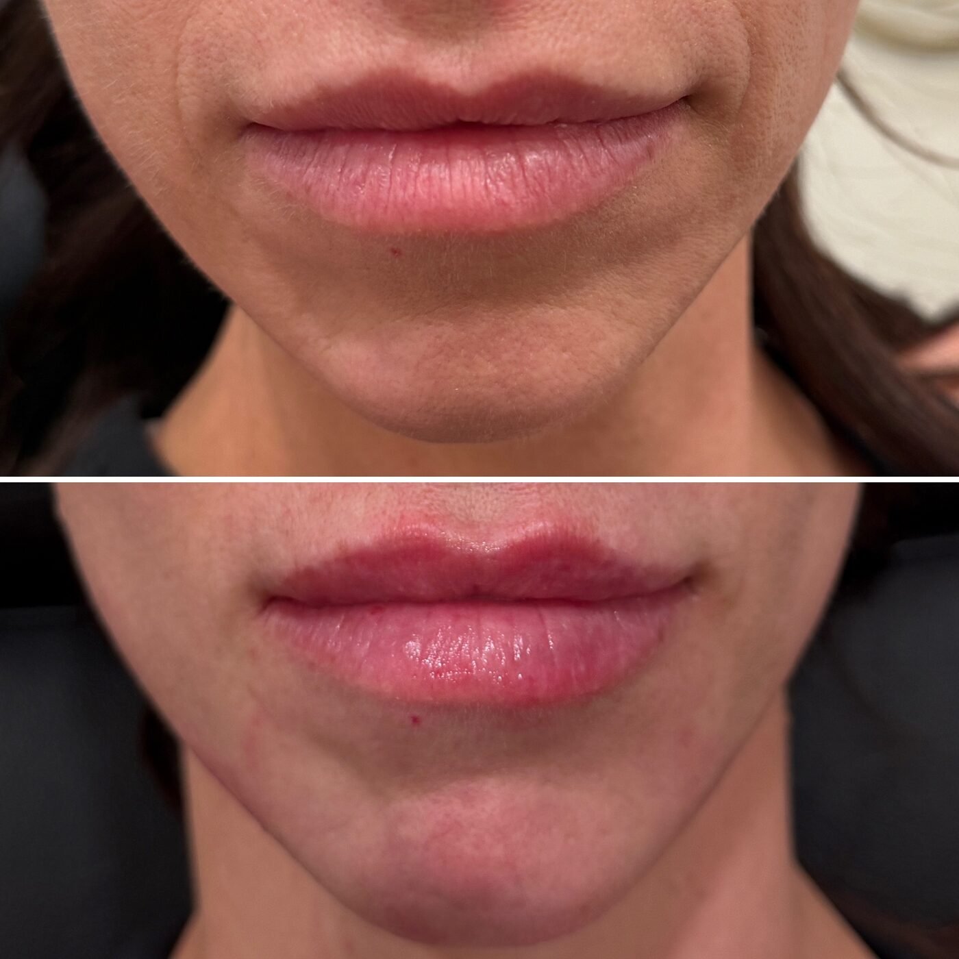 Lip Enhancement before and after — TAI Longevity