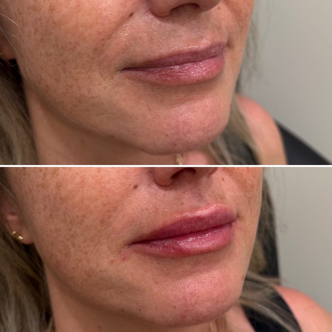 Lip Enhancement before and after — TAI Longevity