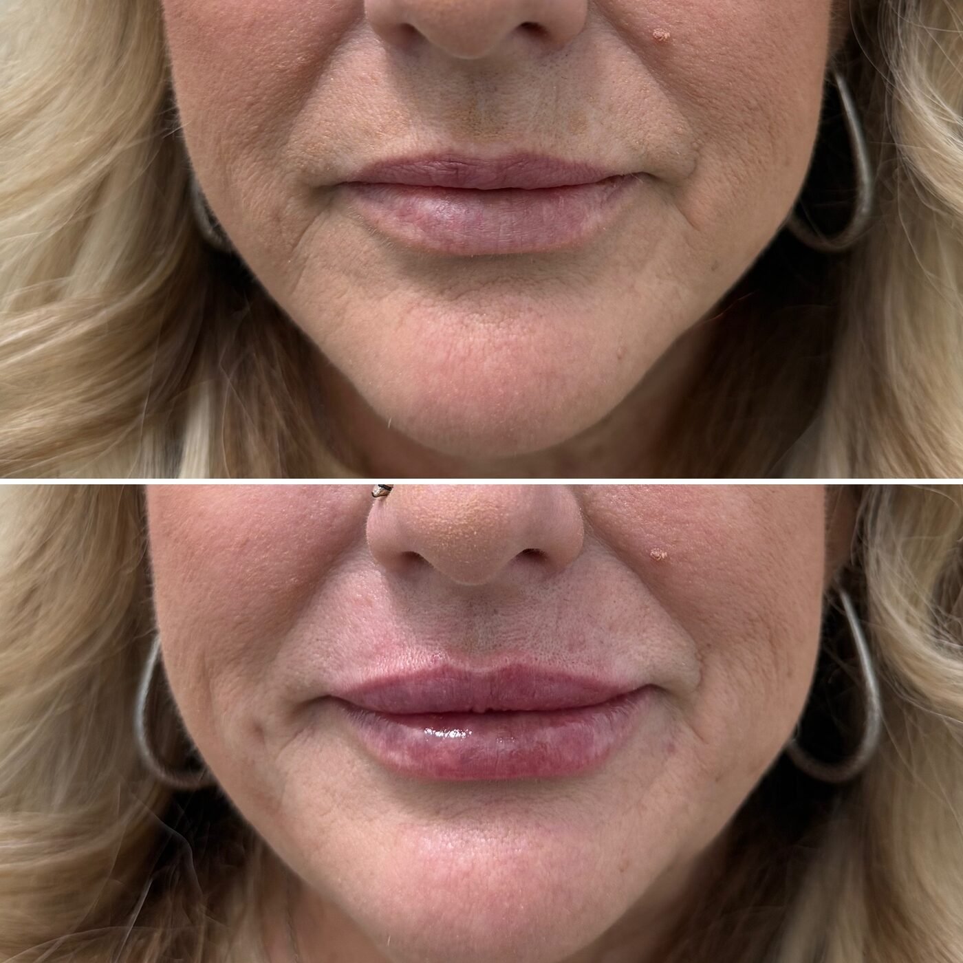 Lip Enhancement before and after — TAI Longevity