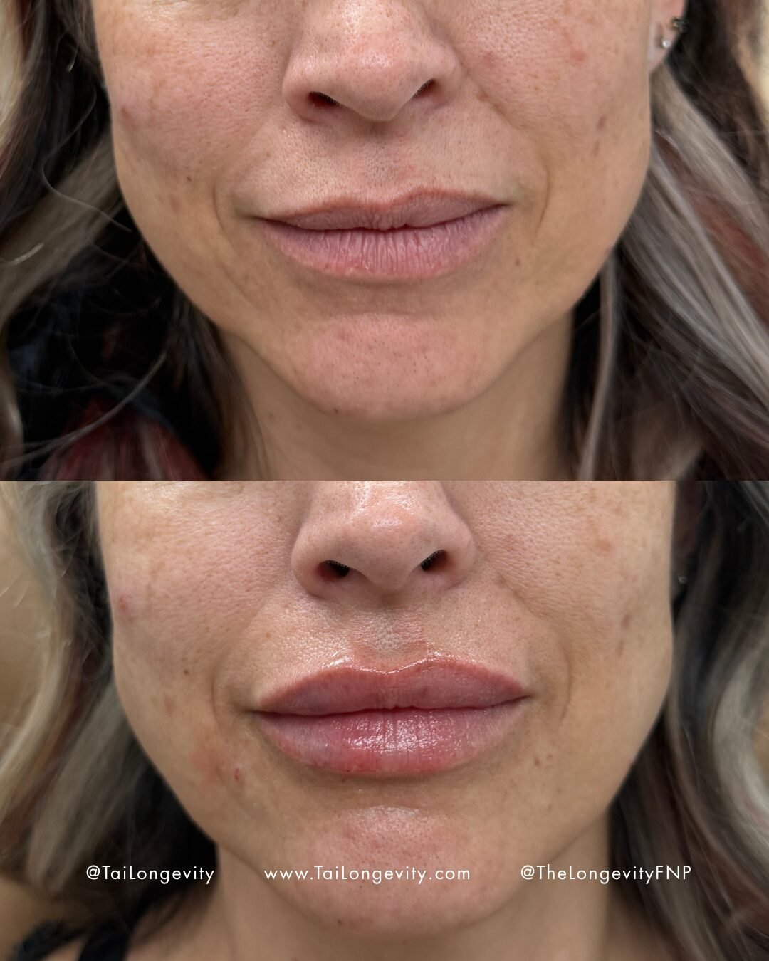 Lip Enhancement before and after — TAI Longevity