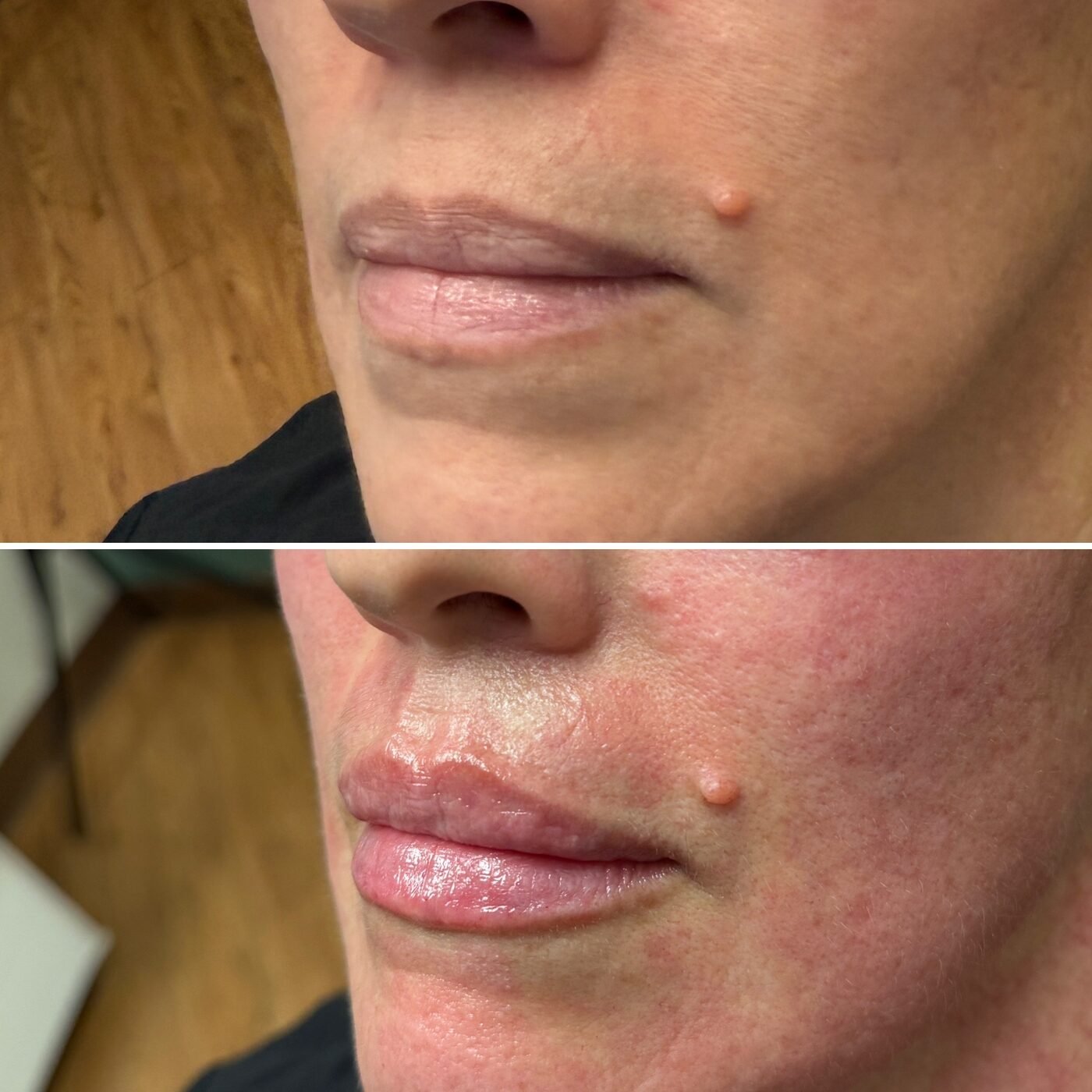 Lip Enhancement before and after — TAI Longevity