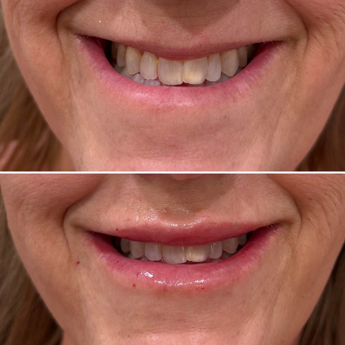 Lip Enhancement before and after — TAI Longevity