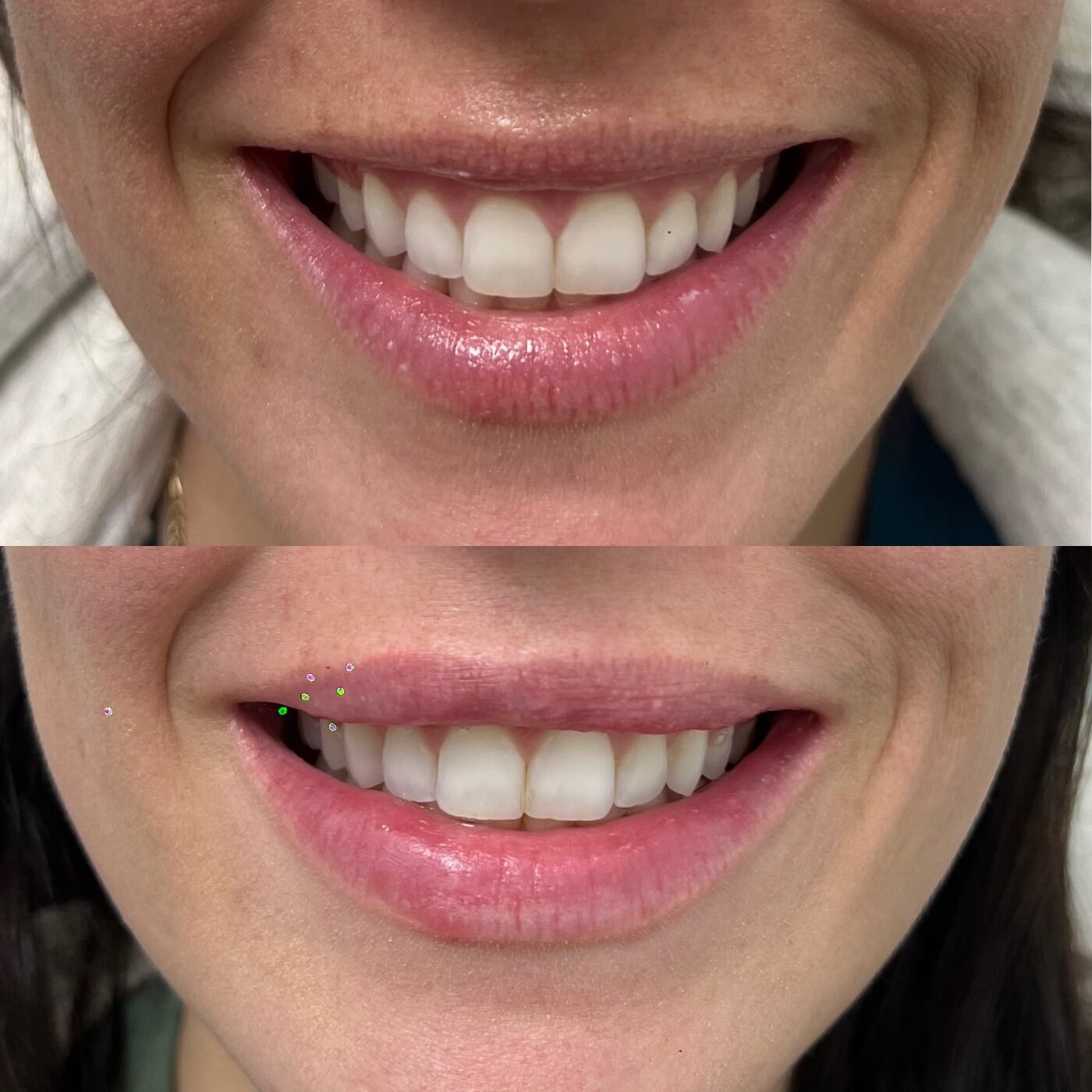 Lip Enhancement before and after — TAI Longevity