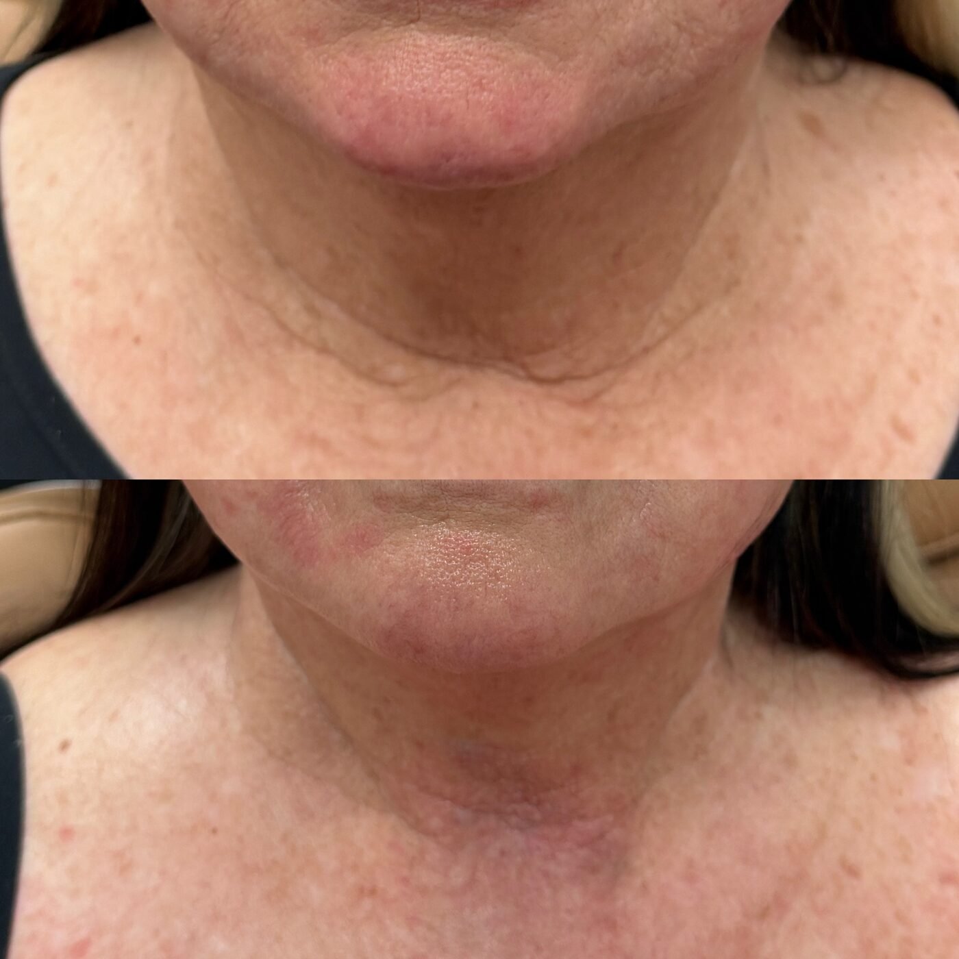 Neck & Jawline before and after — TAI Longevity