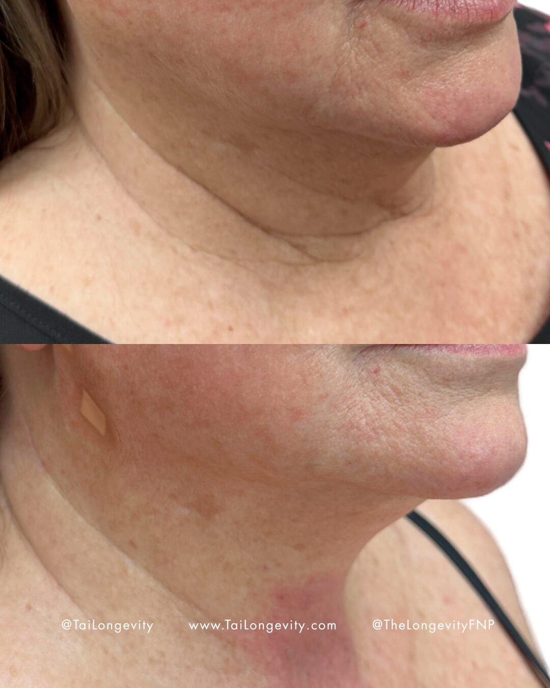 Neck & Jawline before and after — TAI Longevity