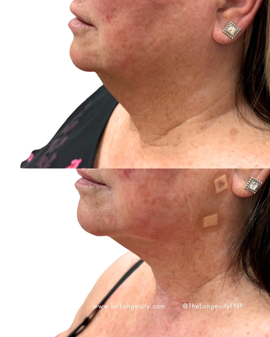 Neck & Jawline before and after — TAI Longevity