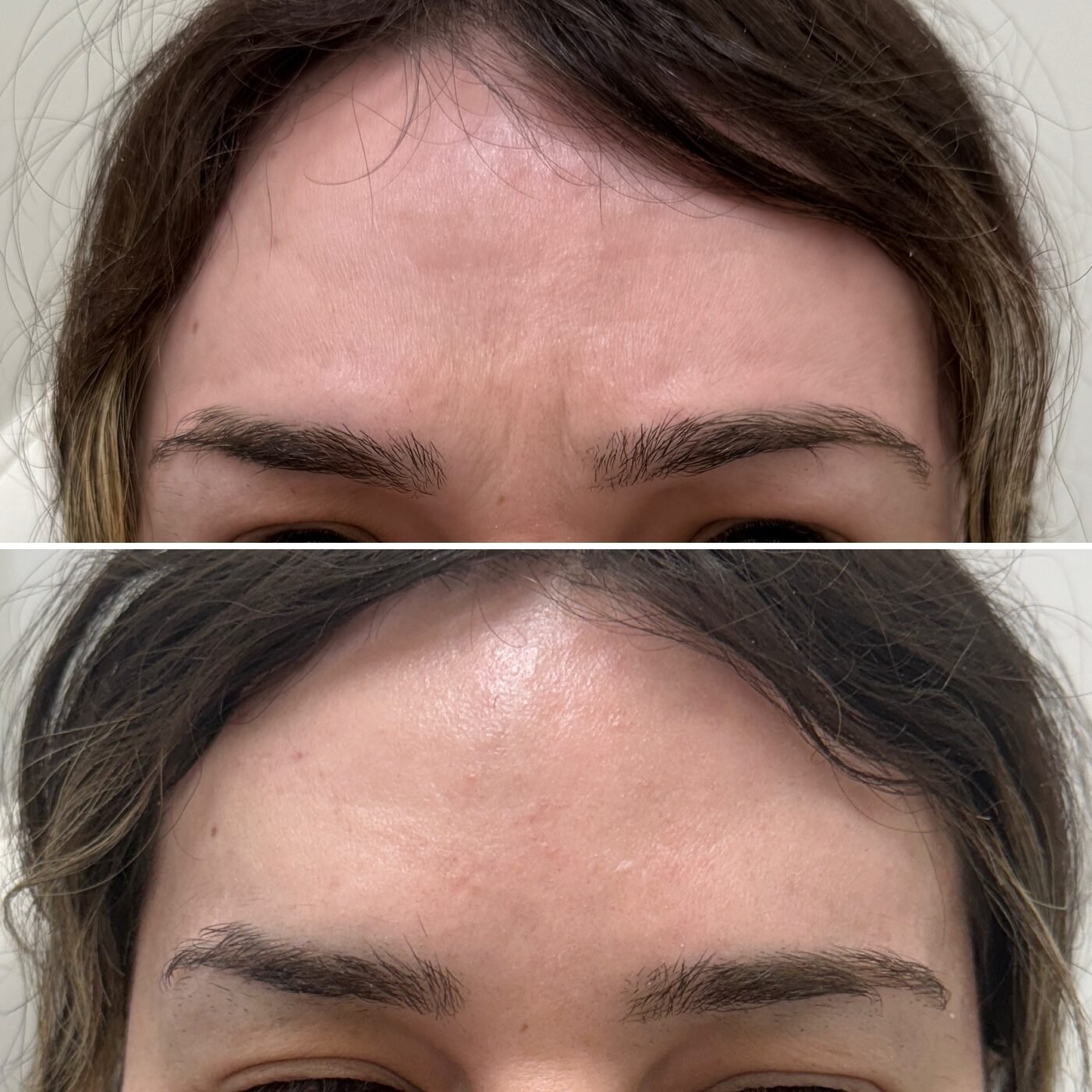 Wrinkle Relaxer before and after — TAI Longevity