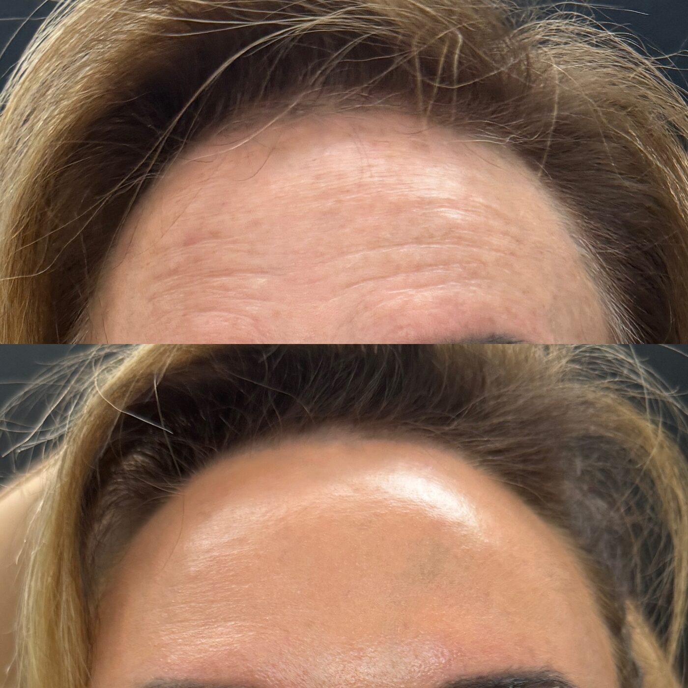 Wrinkle Relaxer before and after — TAI Longevity
