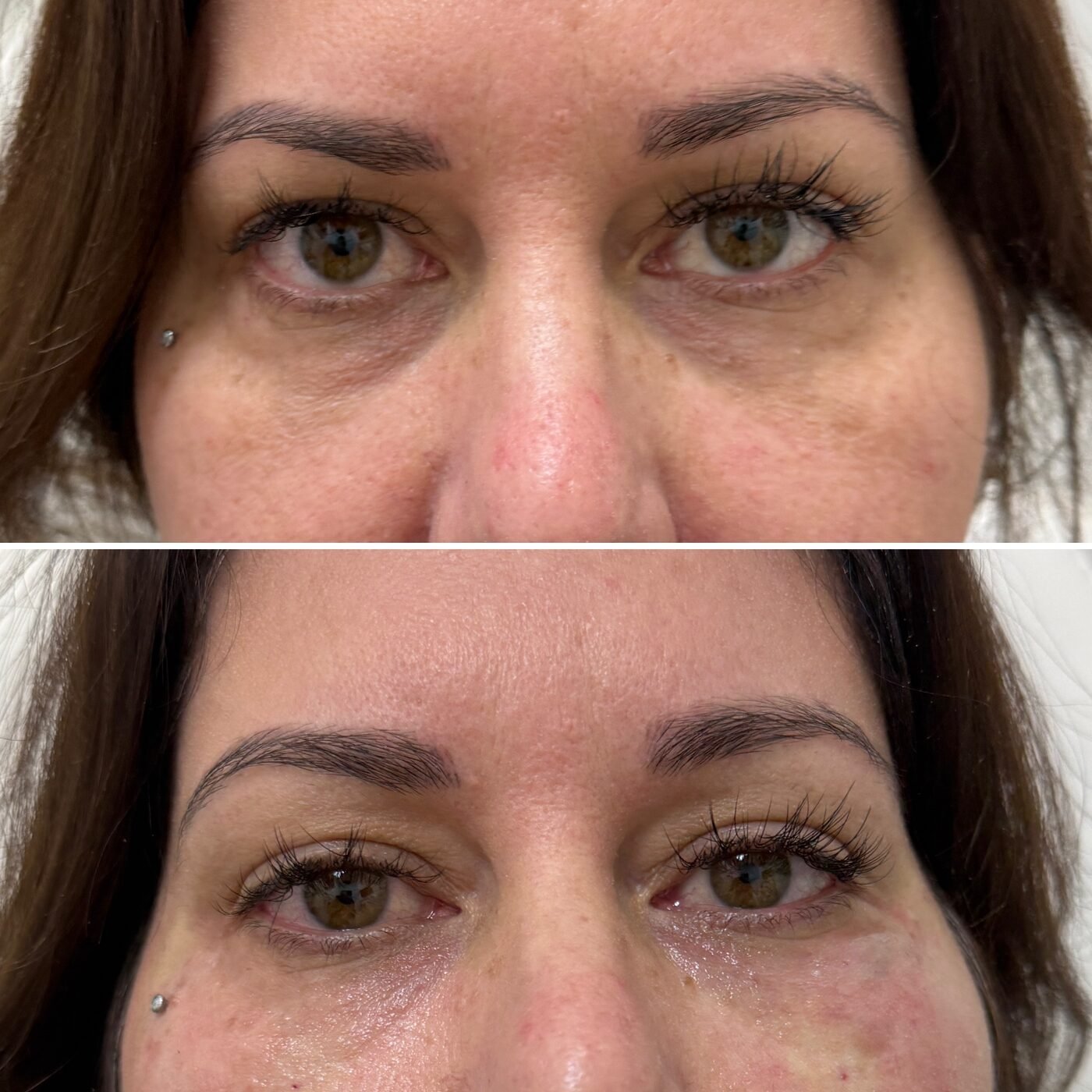 Under-Eye before and after — TAI Longevity