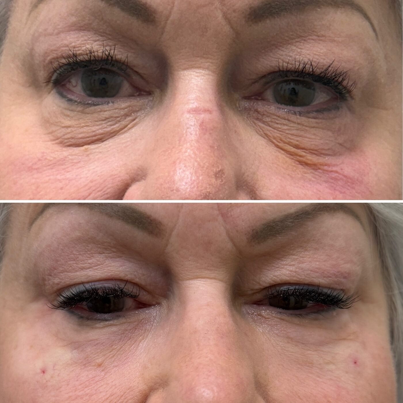 Under-Eye before and after — TAI Longevity